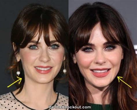 Zooey Deschanels plastic surgery